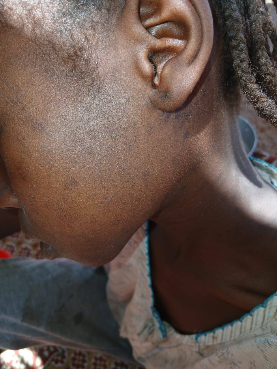 طفلة مصابة في مستشفى كبكابية الريفي - ابريل 2026-غرفة طوارئ محلية كبكابية